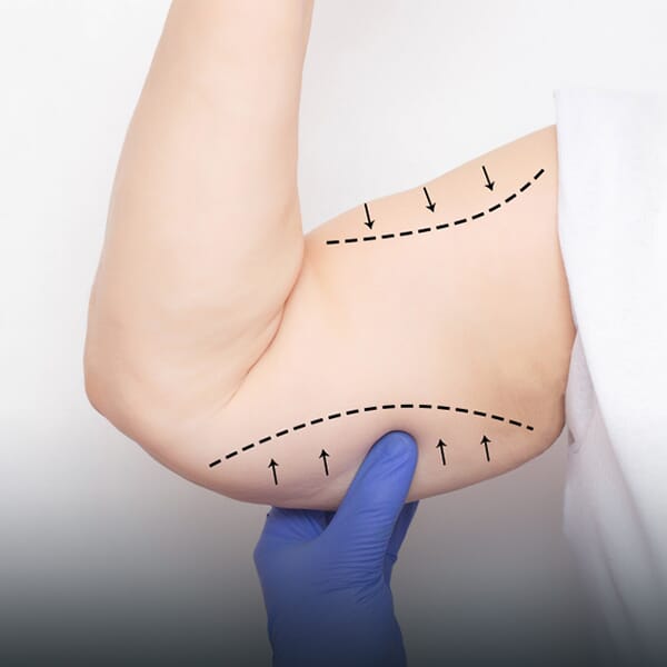 Arm Lift Surgery Brachioplasty: Reshape Your Arms