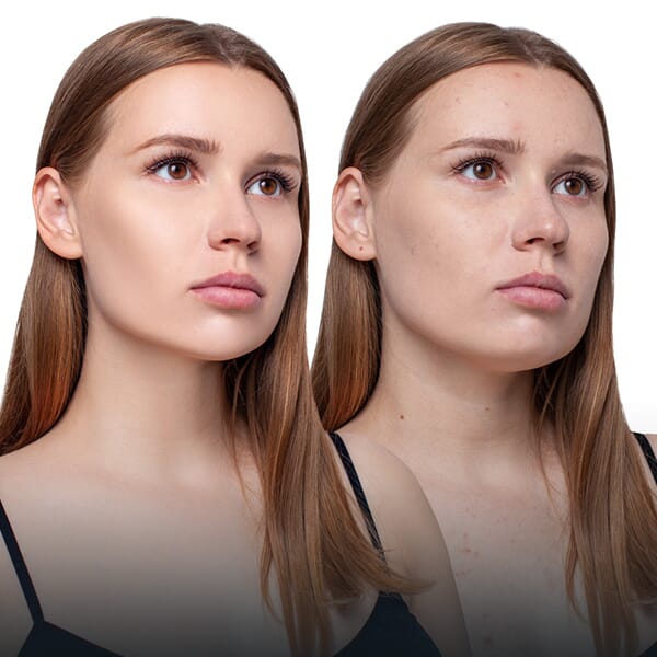 Buccal Fat Removal: Enhance Your Facial Contours