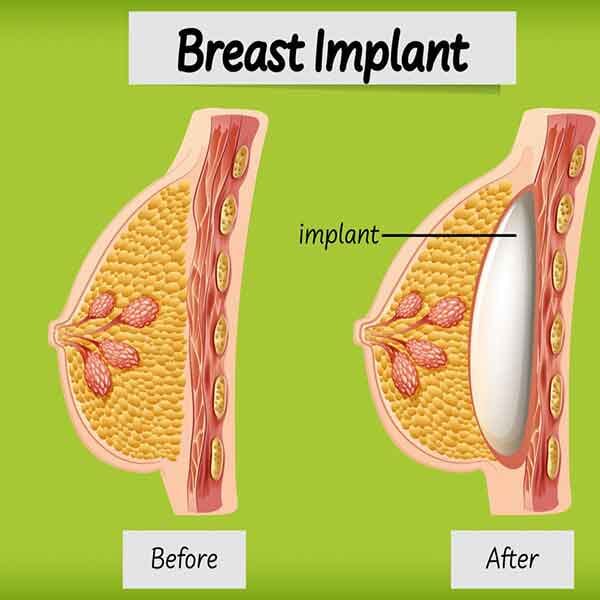 Breast Implant Removal